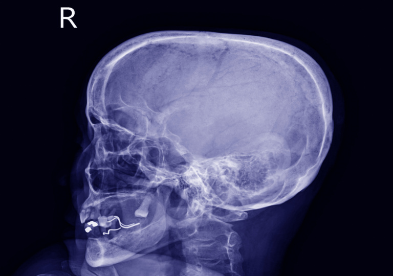X Ray Skull Finding The Cranial Vault Is Intact.No Abnormal Intra Cranial Calcification Or Pneumocephalus Is Noted.The Sella Turcica Looks Narmal.Medical Image Concept.